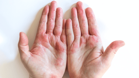 Is Eczema Hereditary? A Look at the Genetics Behind the Condition