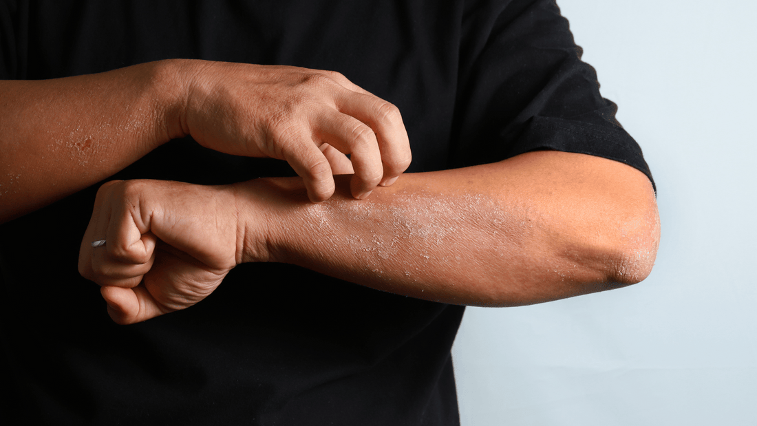 Natural Ways To Manage Eczema Relief