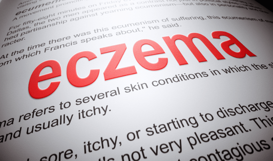 Top 5 Benefits of Using CBD Oil for Eczema