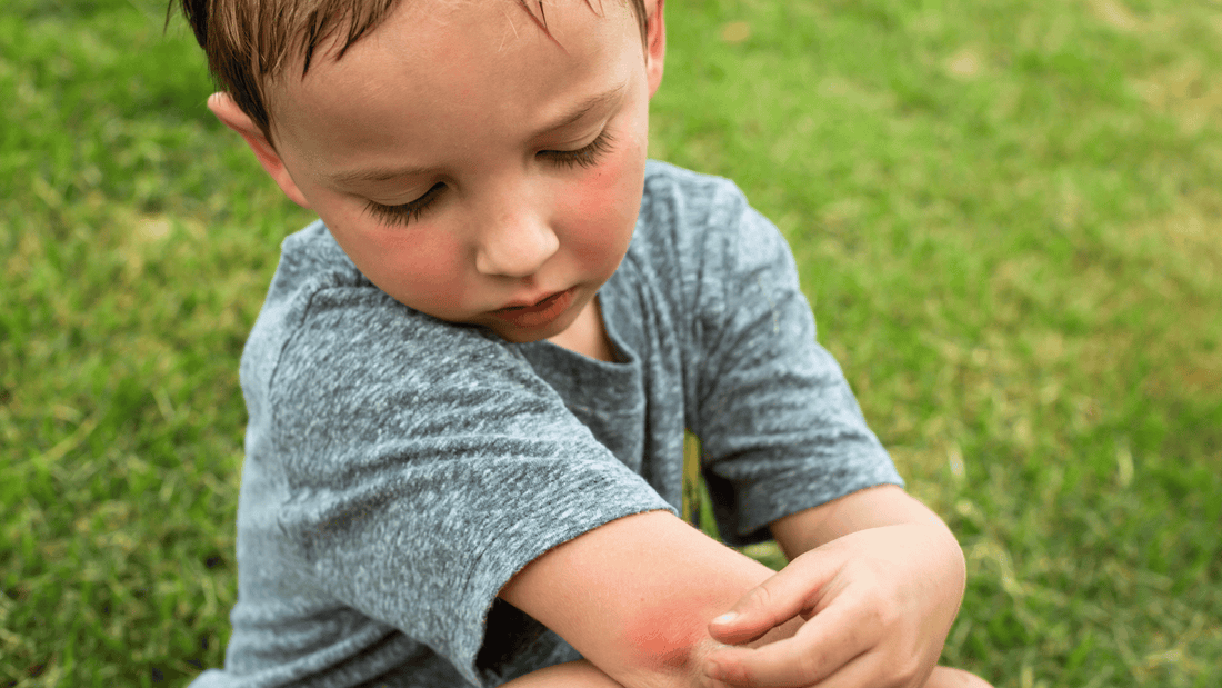 A Comprehensive Guide to Treating Mosquito Bite Infections